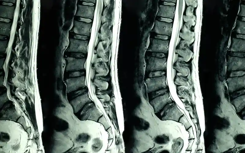 gerinc röntgen, MRI