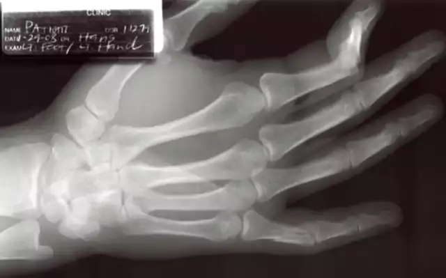 kéz röntgen